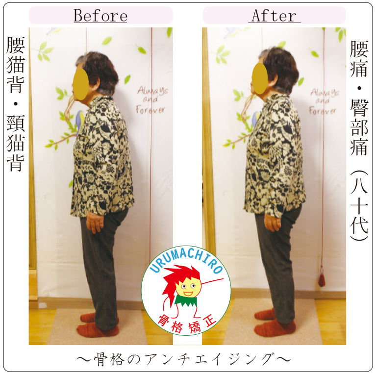 腰猫背への整体ビフォーアフター