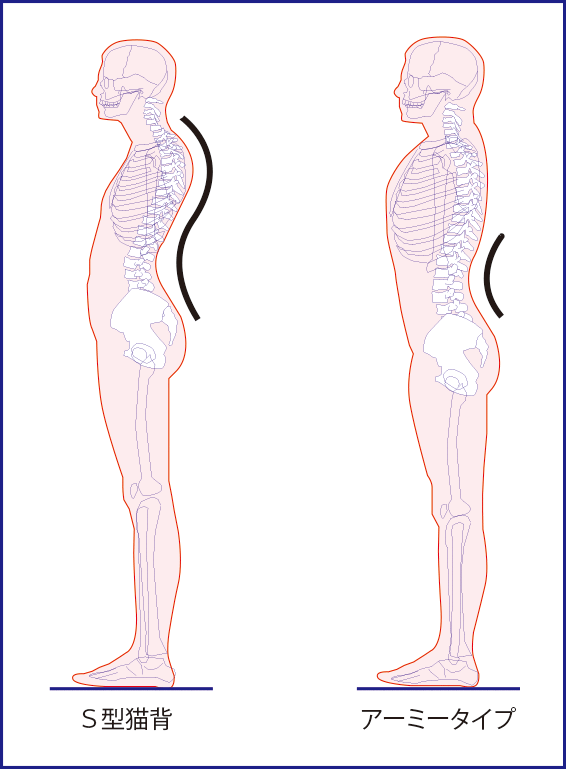 図３：腰椎過前弯