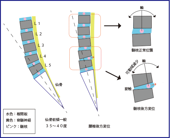 図１３：椎間板の変位