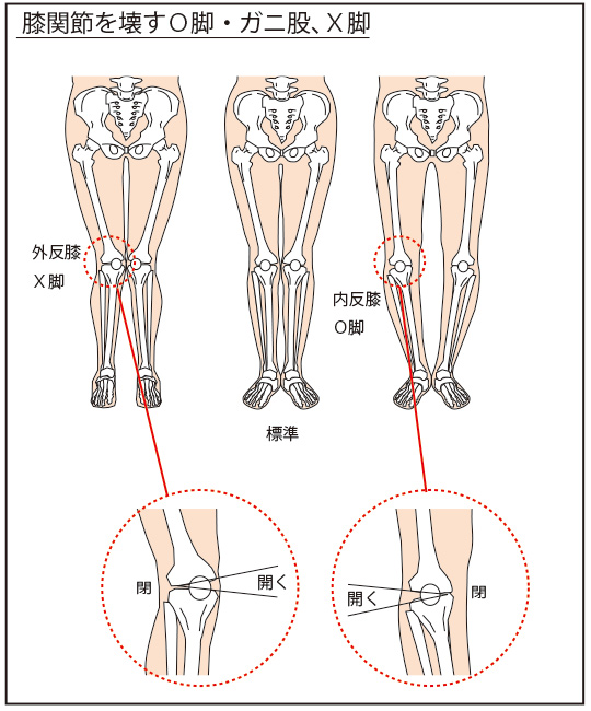図１２：膝関節を壊す膝関節の歪み（Ｏ脚・ガニ股、Ｘ脚）