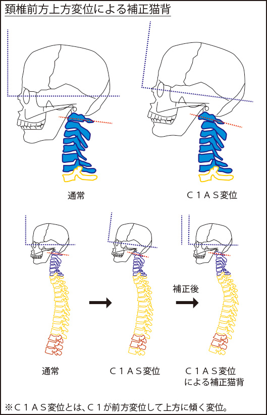 図２：頸椎前方上方変位による補正猫背