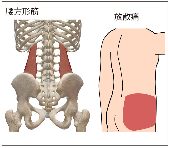 腰方形筋のトリガーポイントによる放散痛位置