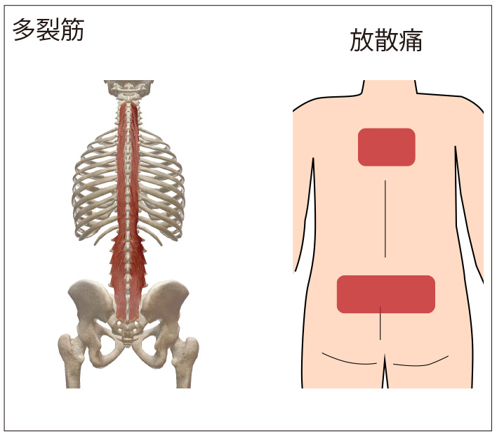 多裂筋のトリガーポイントによる放散痛位置