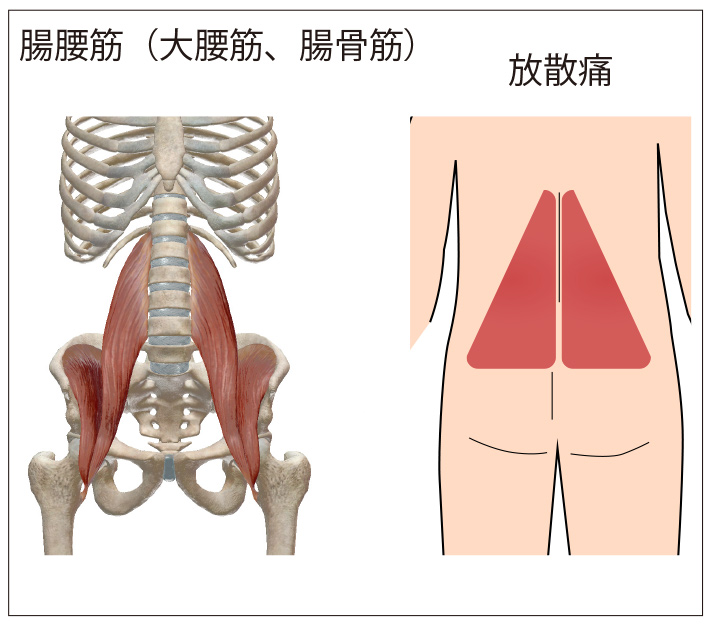 腸腰筋のトリガーポイントによる放散痛位置