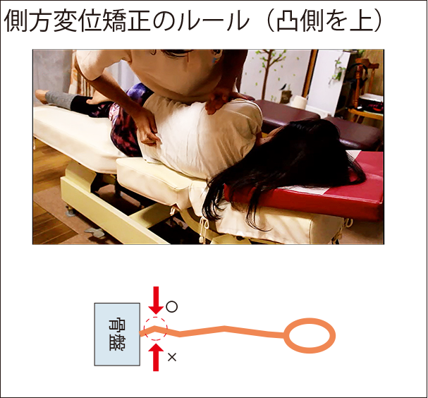 背骨の側方変位への矯正方法。
