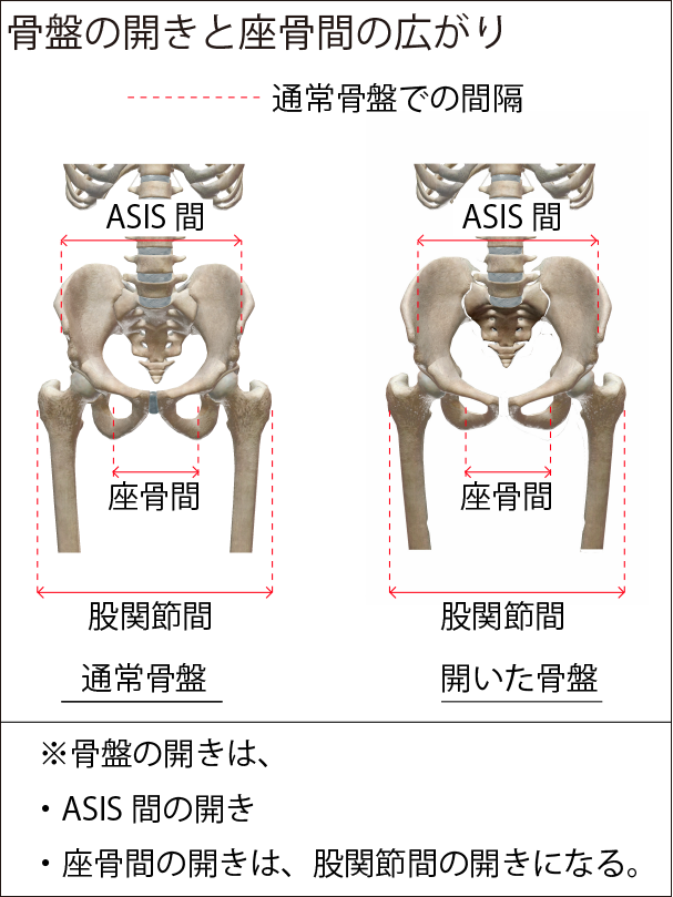 骨盤の開きは、両ＡＳＩＳ間、座骨間、股関節間を拡大させる。