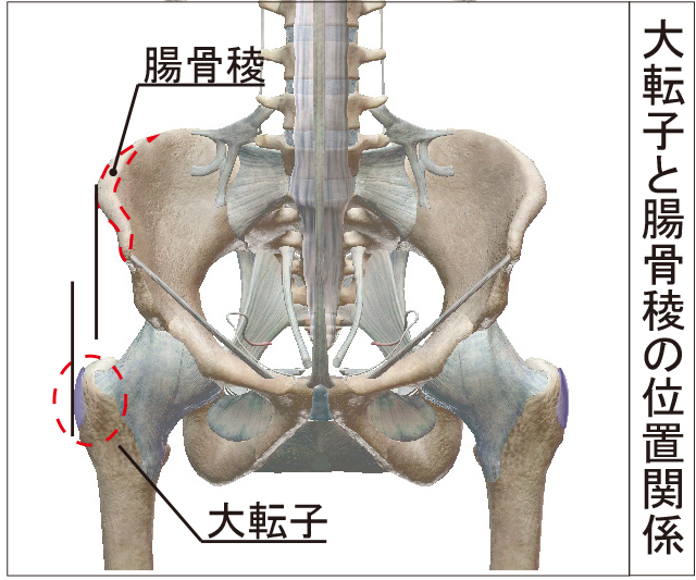 骨盤の開き（大転子と腸骨稜の位置関係）