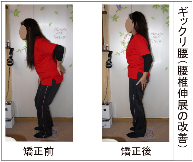 ギックリ腰、腰椎伸展の改善（女性）