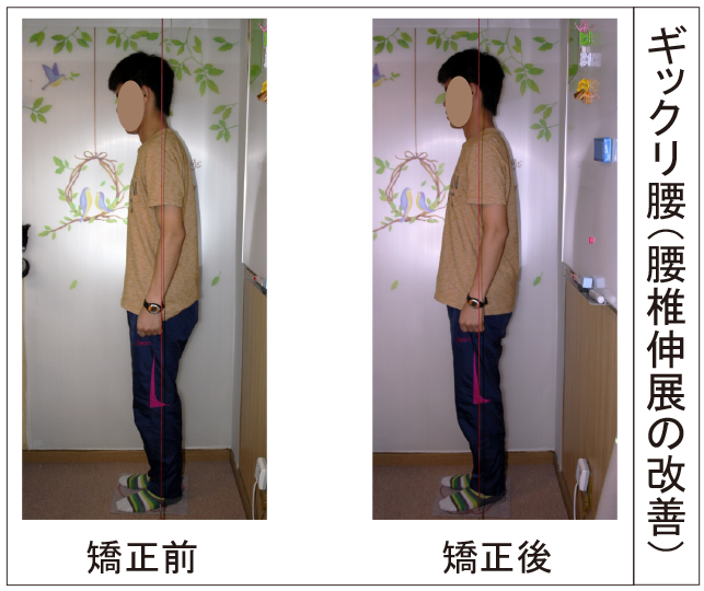 ギックリ腰、腰椎伸展の改善（若い男性）
