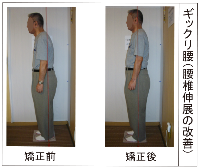 ギックリ腰、腰椎伸展の改善（男性）