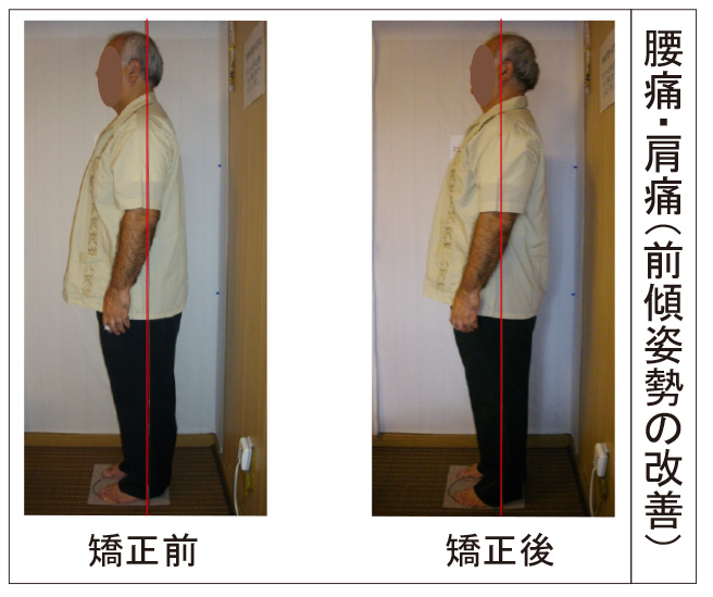 腰痛と肩の痛みがあり、前傾姿勢の改善。