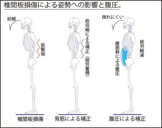 椎間板損傷は、髄核の移動により起こり、背骨が後屈し猫背姿勢になりやすい。