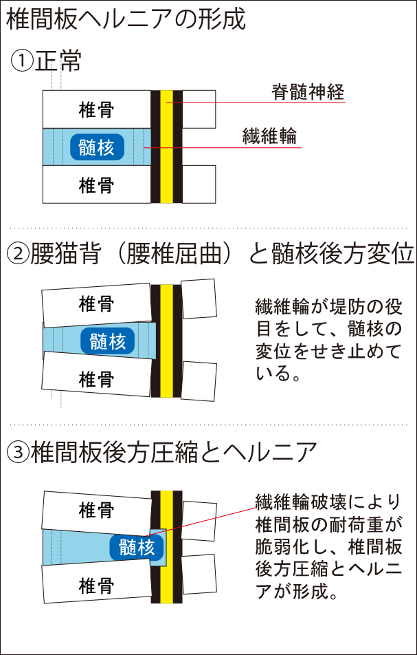 椎間板ヘルニア生成過程