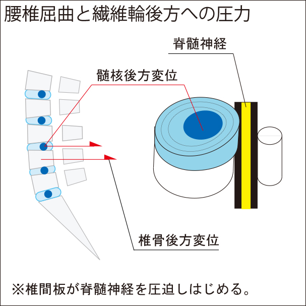 腰椎屈曲と繊維輪後方への圧力