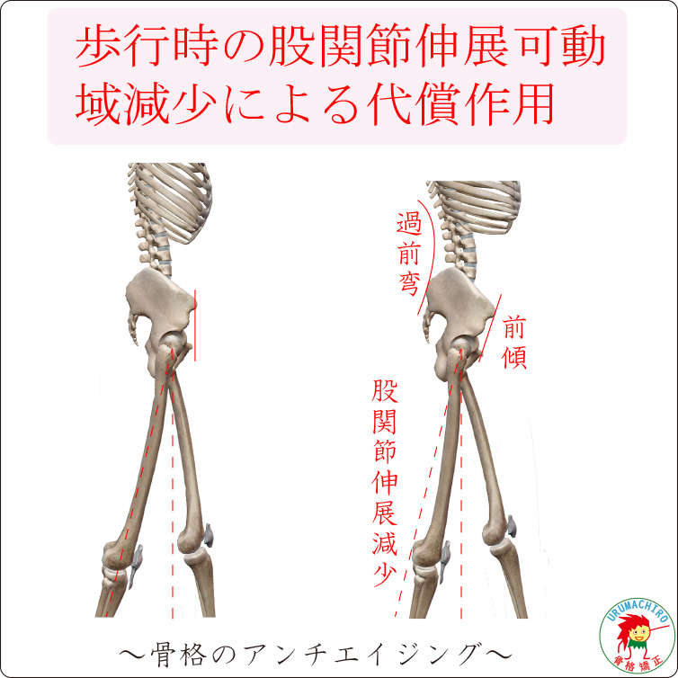 歩行時の股関節伸展可動域減少による代償（骨盤前傾と腰椎過前弯）
